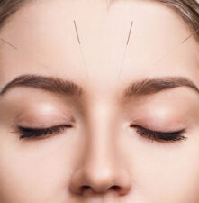 Akupunktura kosmetyczna